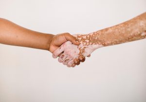 25. lipnja – Svjetski dan oboljelih od vitiliga